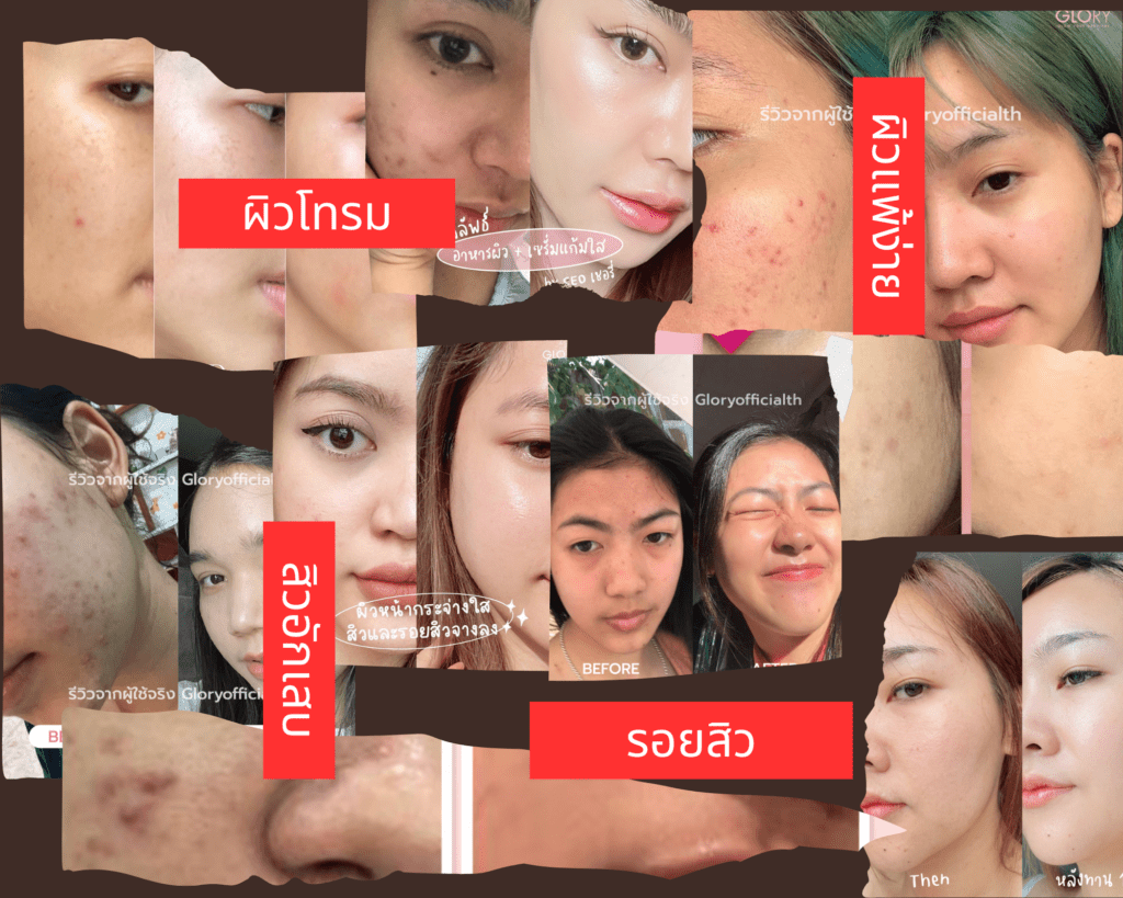 problem_gloryปัญหาผิวcollagen